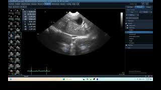 IQ 229 TFAST LUNG ULTRASOUND ECHOPAC ANALYSIS [upl. by Pulling]