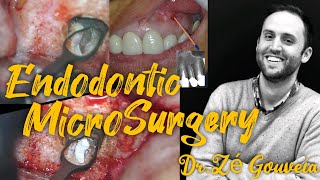 Endodontic Microsurgery  Root canal treatment  Dr Zé Gouveia [upl. by Ugo]