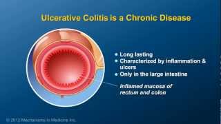 What is Ulcerative Colitis [upl. by Lorenzo464]