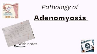 Adenomyosis Pathology [upl. by Aimar580]