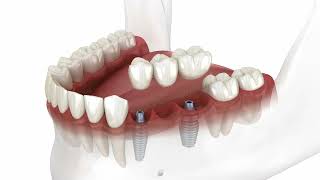 Fogpótlások fogászati implantátumra helyezve [upl. by Bolt]