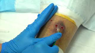 Thornys Leg Abscess Extended Raw Cut by MetaSeven [upl. by Ahlgren]