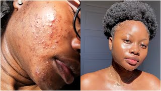 my skincare routine for acne amp scars finally [upl. by Nivled]