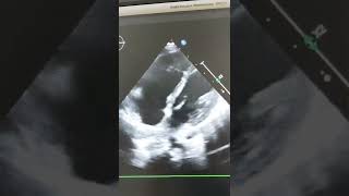 ebstein anomaly  septal leaflet of tricuspid valve is displaced distally in Right ventricle [upl. by Carbrey]