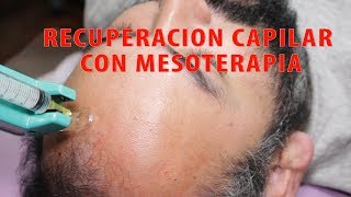 Tratamiento de recuperación capilar con MESOTERAPIA ALOPECIA [upl. by Jon]