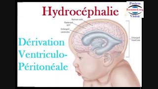 Hydrocéphalie et dérivation ventriculopéritonéale du liquide cérébrospinal [upl. by Silverman]