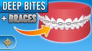 How Do Braces Fix Deep Bites  Premier Orthodontics [upl. by Adnilreh]