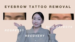 MY EYEBROW TATTOO REMOVAL EXPERIENCE SALINE REMOVAL amp NEW LASER TECH  除眉心路歷程 [upl. by Greff]