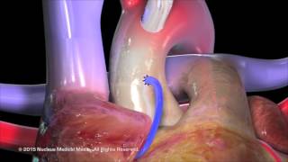 Coronary Artery Bypass Grafting CABG [upl. by Ahsinyt]