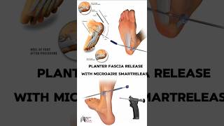 Planter Fascia Release with MicroAire SmartRelease medical animation 3d short [upl. by Ecinehs]