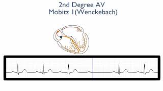 2nd Degree AV Block Mobitz Type 1 Wenckebach [upl. by Mccourt]