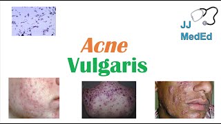 Acne Vulgaris  Causes Pathogenesis Influencing Factors Diagnosis Treatment and Complications [upl. by Ardnuat856]