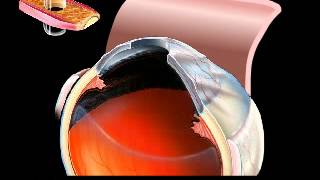 OsteoOdontoKeratoprosthesis Procedure Artwork by Stephen F Gordon [upl. by Foscalina382]