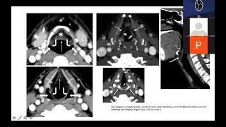 Role of PET CT In Larynx and Hypopharynx Carcinoma BY DR SAYAK CHOUDHARY [upl. by Savior201]