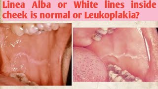 Linea Alba or White lines inside cheek is normal or Leukoplakia [upl. by Geiss200]