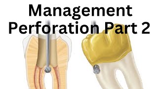 Endodontic Perforation management Prognosis amp Treatment Part 2 [upl. by Asena]