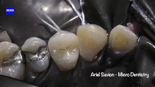 Restoring Teeth without Root Canal Treatment Effective Caries Removal and Crown Restoration [upl. by Herby]