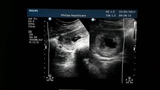 Subchorionic Hemorrhage Ultrasound [upl. by Ghassan263]