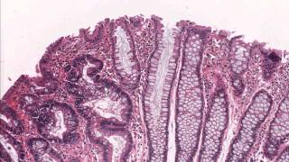 Colon tubular adenoma demonstrating low grade dysplasia  Microscopic diagnosis [upl. by Morie]