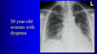 14b ILD P 2 Lower lung interstitial Disease [upl. by Demetre646]