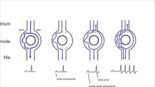 AVNRT AV nodal reentrant tachycardia [upl. by Annua626]