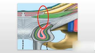 Inguinal Hernias Explained [upl. by Docilu]