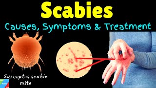 Scabies Causes Symptoms Diagnosis Treatment amp Prevention [upl. by Nnaitak]