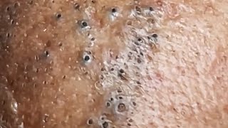 Blackheads amp Whiteheads Satisfying Removal 0050 [upl. by Ymmas]