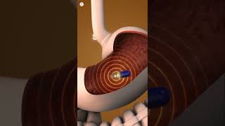 Capsule Endoscopy shorts shortvideo [upl. by Sacrod57]