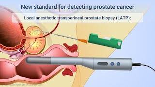 Transperineal Prostate Biopsies Under Local Anesthesia [upl. by Nelhsa]