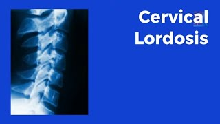 Cervical Lordosis  What Is It and What Is It And Why Is It Important  Tebby Clinic [upl. by Steffen]