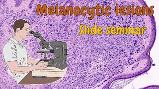 Melanocytic lesions ENG [upl. by Micaela]