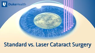 Standard vs Laser Cataract Surgery  Duke Health [upl. by Yrohcaz]