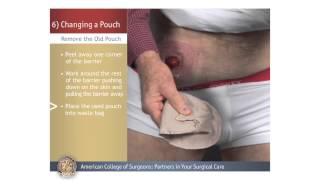 ColostomyIleostomy Changing a Pouch [upl. by Dagley]