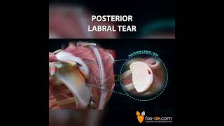 Posterior Labral Tear [upl. by Innis]