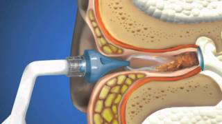 Bionix® OtoClear® Ear Irrigation [upl. by Frydman]