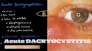 Acute Dacryocystitis  lacrimal system [upl. by Blunt219]