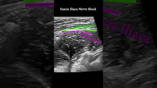 Fascia Iliaca Plane Block ultrasound nerveblock anatomy [upl. by Thackeray22]