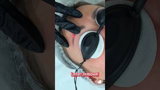 Eyebrows color correction by laser [upl. by Austreng]