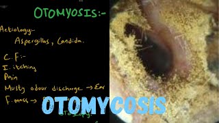 OTOMYCOSIS  Fungal Ear Infection [upl. by Ojyram369]