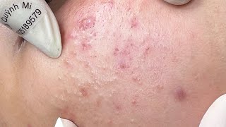 ACNE TREATMENT VU QUYNH MI Acne On Boys Chin 2024 [upl. by Sellig]