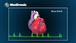 What Is Bradycardia [upl. by Erasme88]