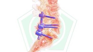 Artrodesis lumbar transpedicular [upl. by Hakan]