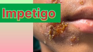 Impetigo in childrenबच्चो में होने बाले फोड़े फ़िन्सी [upl. by Esenaj899]