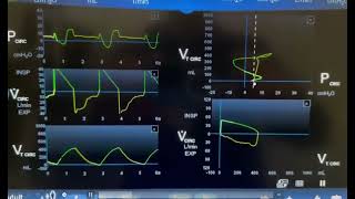 Air Hunger on Mechanical Ventilation [upl. by Sheeree]