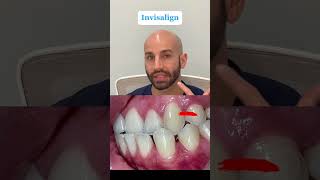 Invisalign To Fix A Front Crossbite [upl. by Delastre]