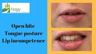 Open bite tongue posture and lip incompetence [upl. by Skier]