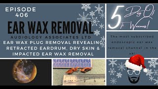 EAR WAX PLUG REMOVAL REVEALING RETRACTED EARDRUM DRY SKIN amp IMPACTED EAR WAX REMOVAL  EP406 [upl. by Donahue]