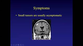 Which Meningiomas Should Not Be Treated [upl. by Gustaf]