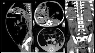 Pneumatosis intestinalis und tödliche portosystemische Luftembolie [upl. by Leonardo]